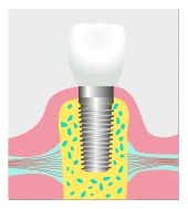dental implant Irvine